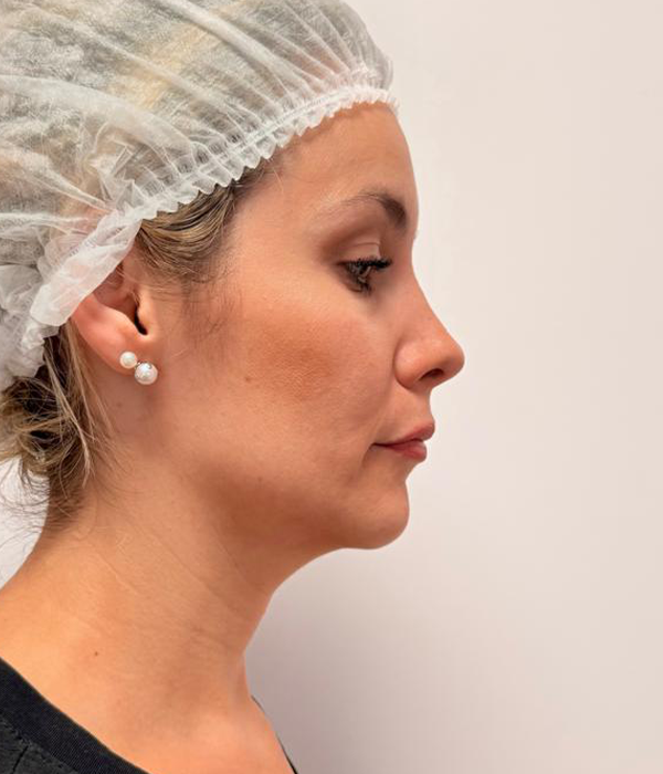 Antes: contorno facial
